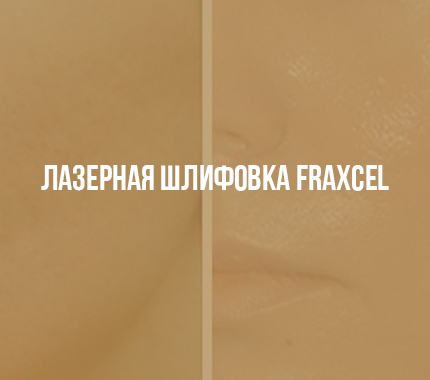 Лазерная шлифовка Fraxcel