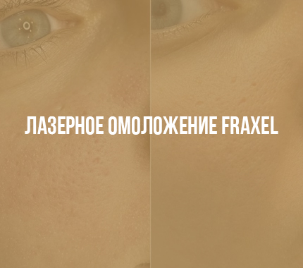 Лазерное омоложение Fraxel