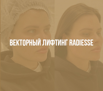 Векторный лифтинг Radiesse